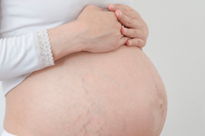 red stretch marks