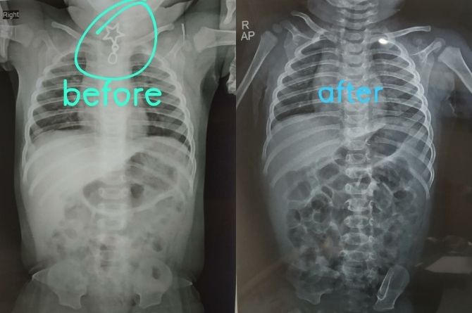 Esophageal foreign body