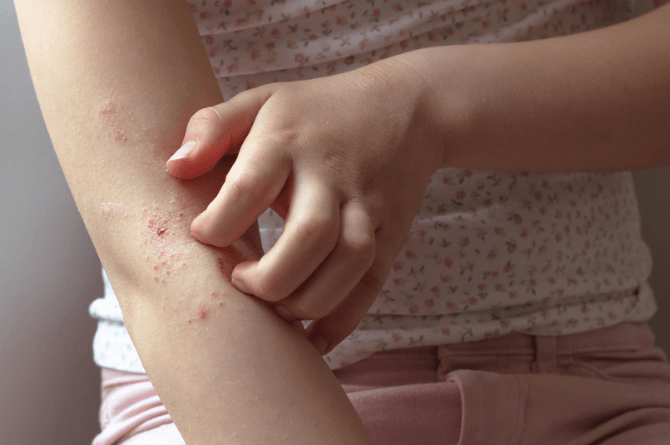atopic dermatitis in kids