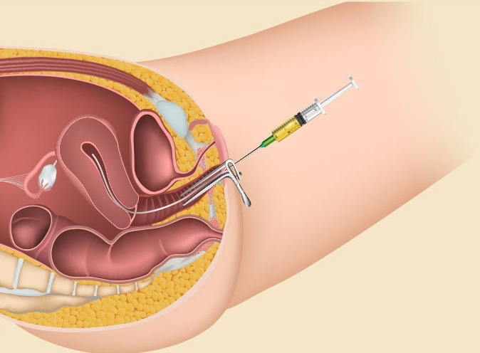 IUI