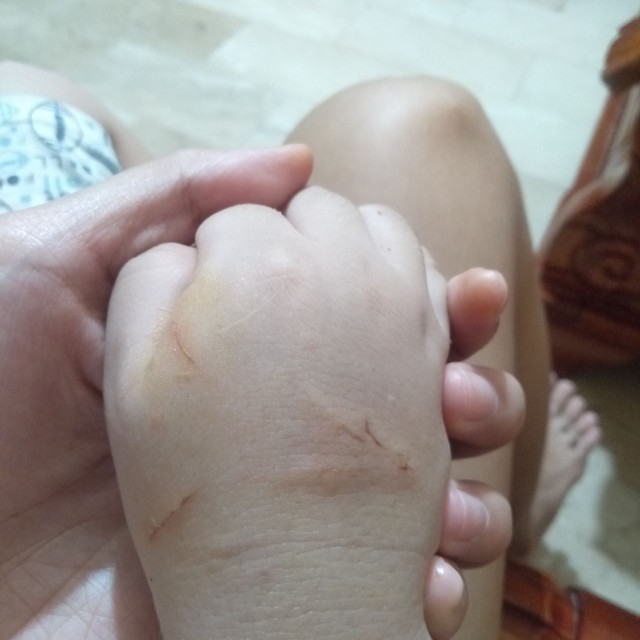 what to do pag nagkascratch hand ni lo dahil sa tuta?