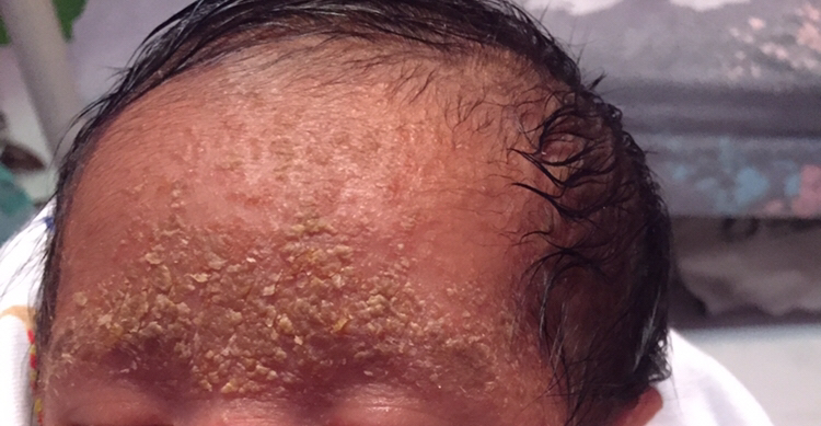 Atopic dermatitis