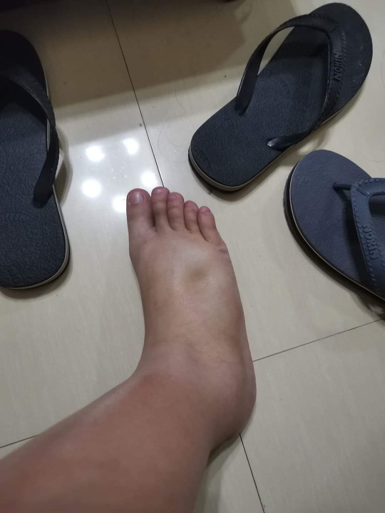 beriberi?