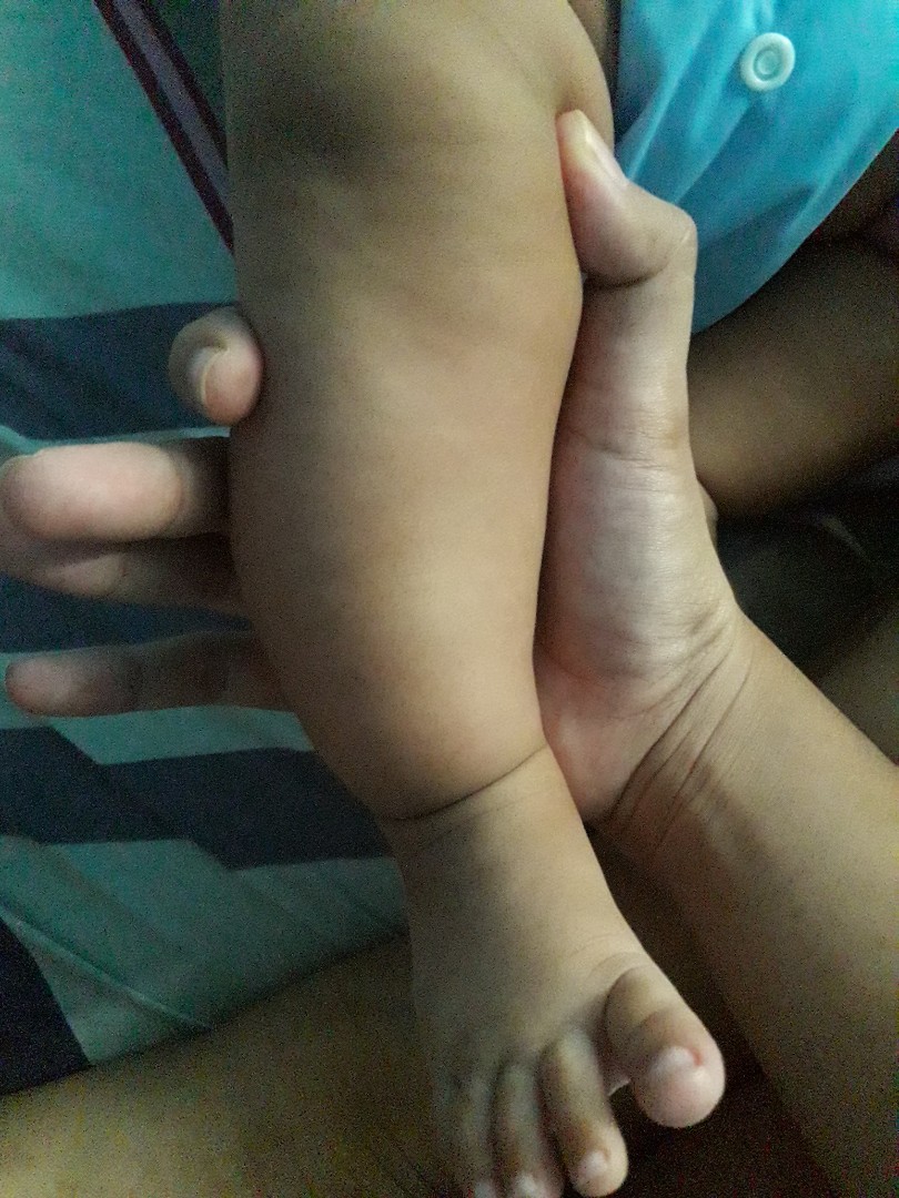 bow leg