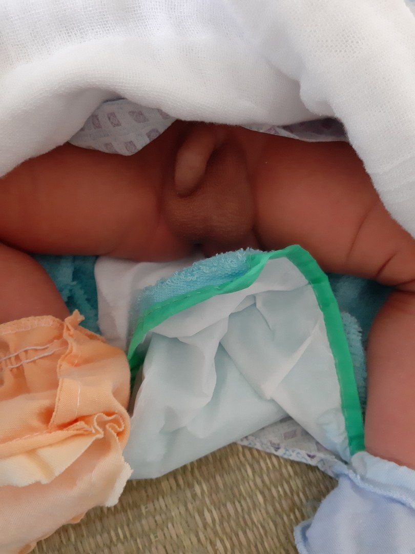 các mom cho e hỏi chút .có mom nào có con bộ phận sd hơi lệch sang bên như này không ạ