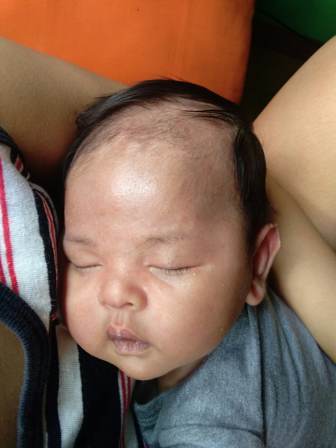 Cradle Cap