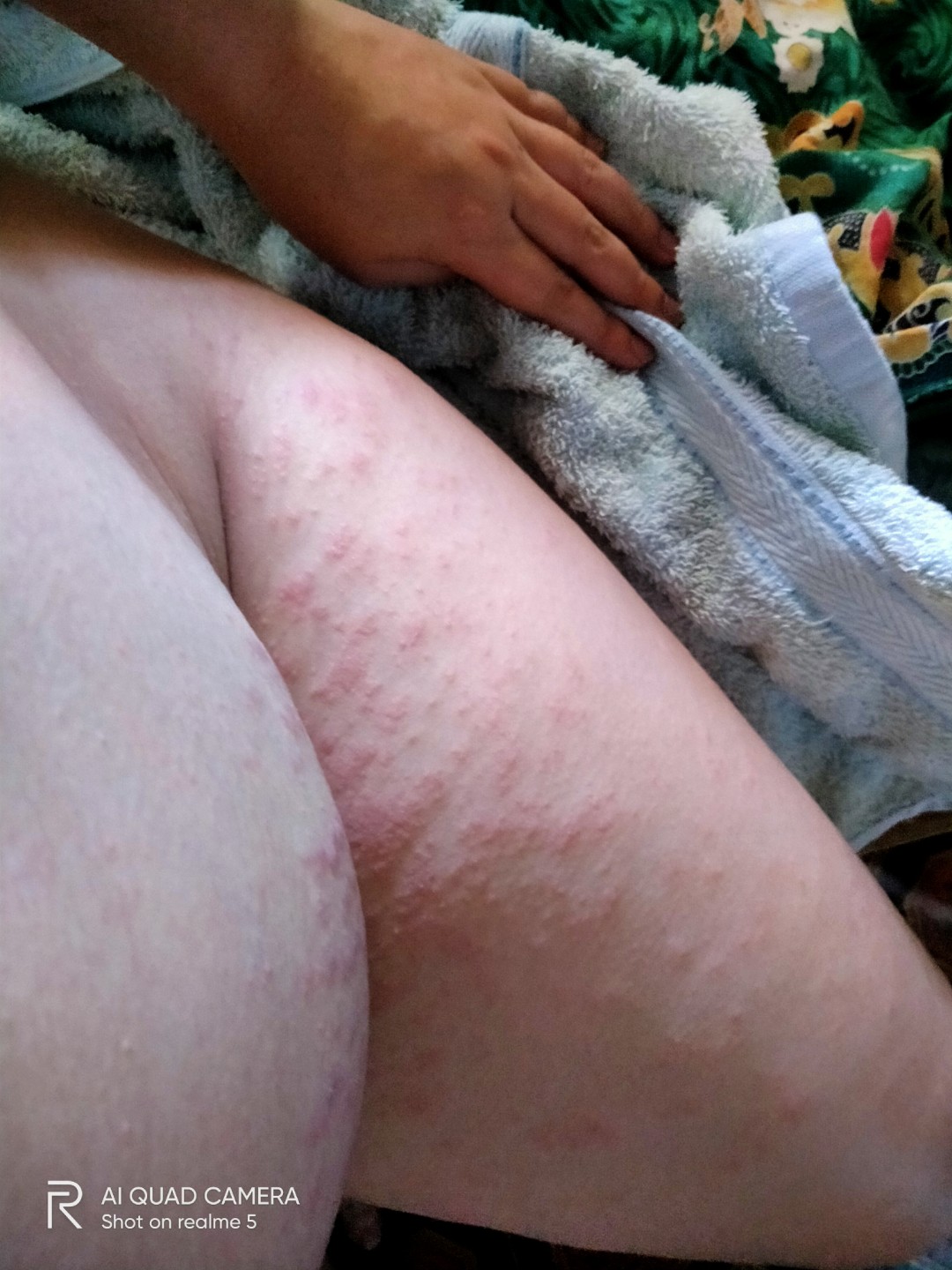 I am 8mos pregnant and suffering from Puppp rash. Sino po naka experience nag Puppp rash kasi yung iba is 1st and 2nd trimester lumalabas ee ang sakin 3rd trimester na. Anyone? Ne recitahan din ba kayo ng Ob niyo ng anti allergies na gamot like cetirizen?