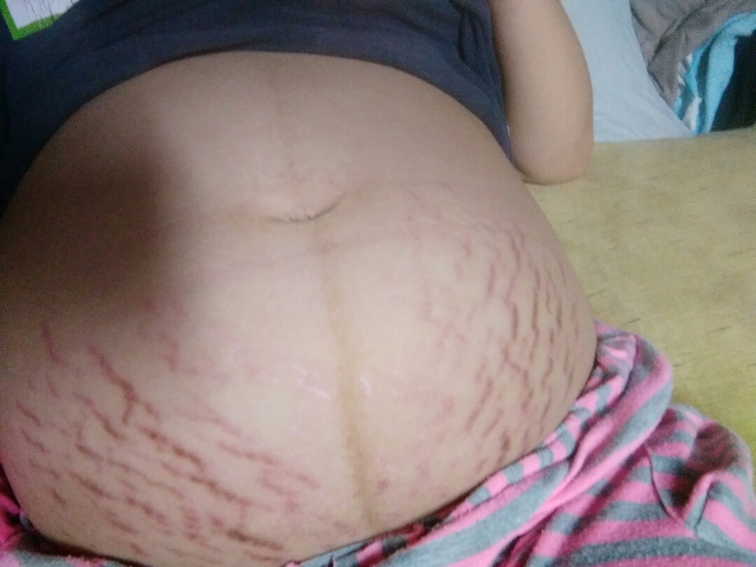strecth marks @36weeks