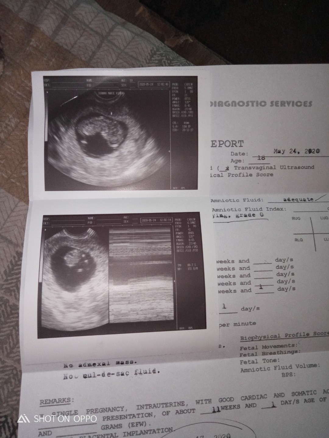 13weeks preggy