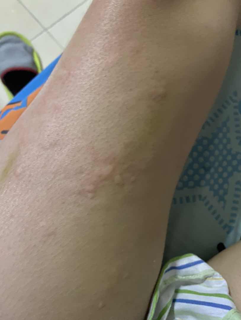 ผื่นคันขึ้น