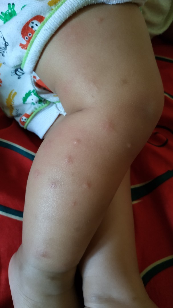 nyamuk atau alergi?