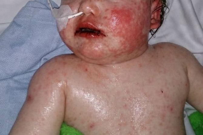 Allergic Reaction To Ibuprofen Nearly Kills This Baby Allergic Reaction To Ibuprofen Nearly Kills This Baby