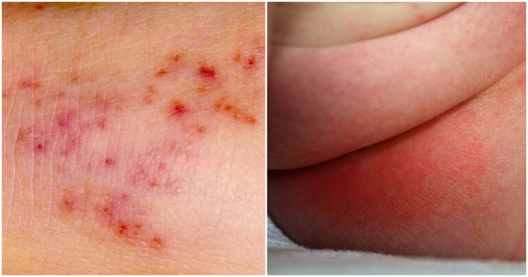 Toddler Rashes 15 Common Skin Conditions That Affect Young Children