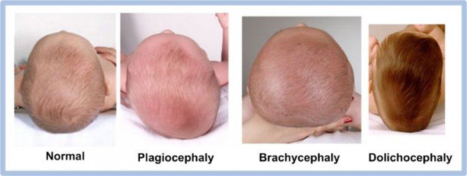 Kepala Peyang Pada Bayi Plagiocephaly Penyebab Cara Menanganinya<script async src=
