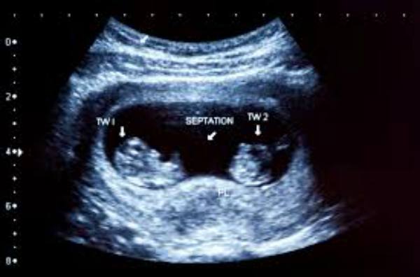 Mengandung Bayi Kembar Satu Janin Menghilang Vanishing Twin Syndrome