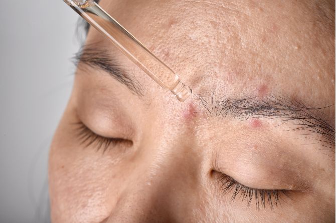 serum wardah untuk kulit berjerawat dan bekas jerawat