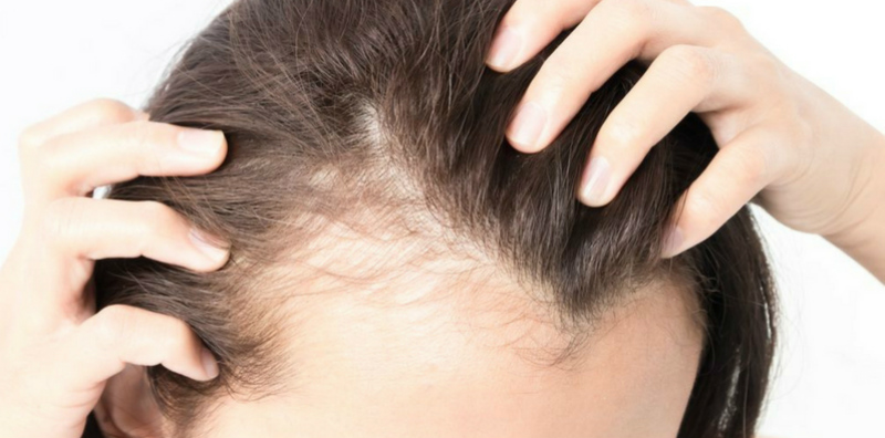 Mengatasi Rambut Rontok dengan Merang, Bawang, dan Perasaan Bahagia