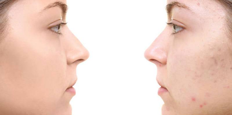 9 Best Foods for Acne Scars