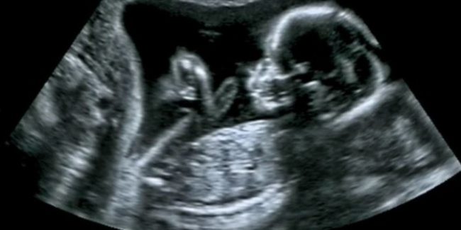 Miscarriage Tissues At 4 6 Weeks What They Reveal - pep8h5a