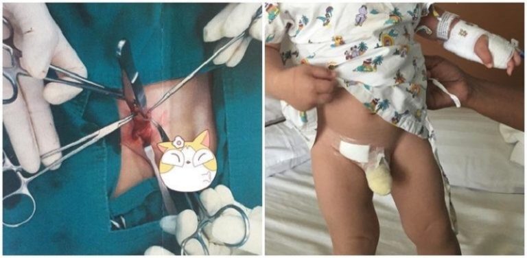 Hernia Pada Bayi Ketahui Tanda Tanda Hernia Sebelum Terlambat