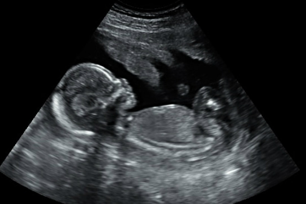 Scan Kehamilan Bila Waktu Sesuai Untuk Buat Imbasan Ultrasound