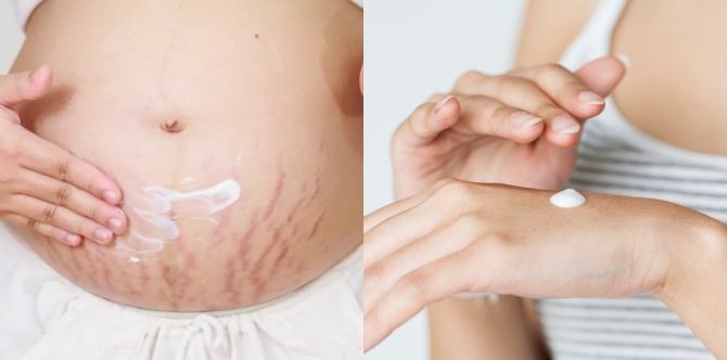 Ada Stretch Mark Atau Tidak Suami Tetap Sayang, Tapi Ini 7 Jenama Krim Stretch Mark Terbaik Untuk Anda Cuba